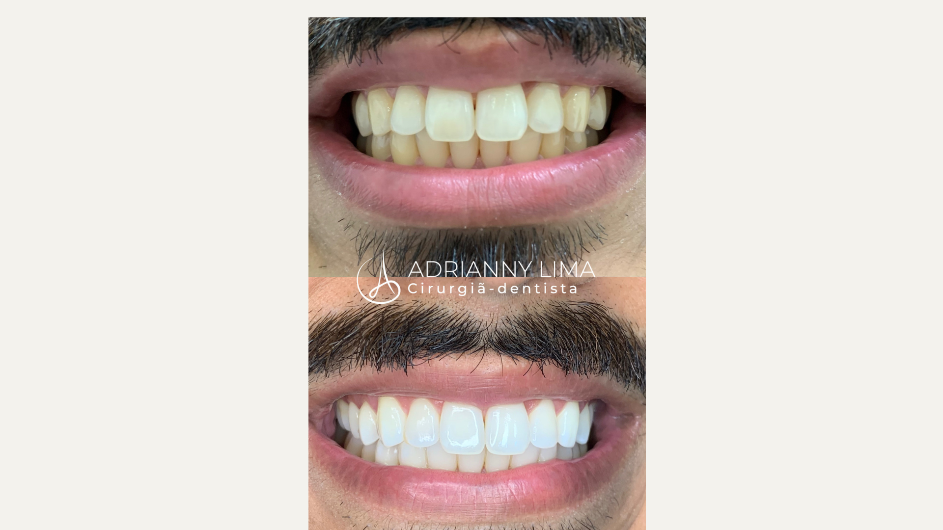Clareamento Dental