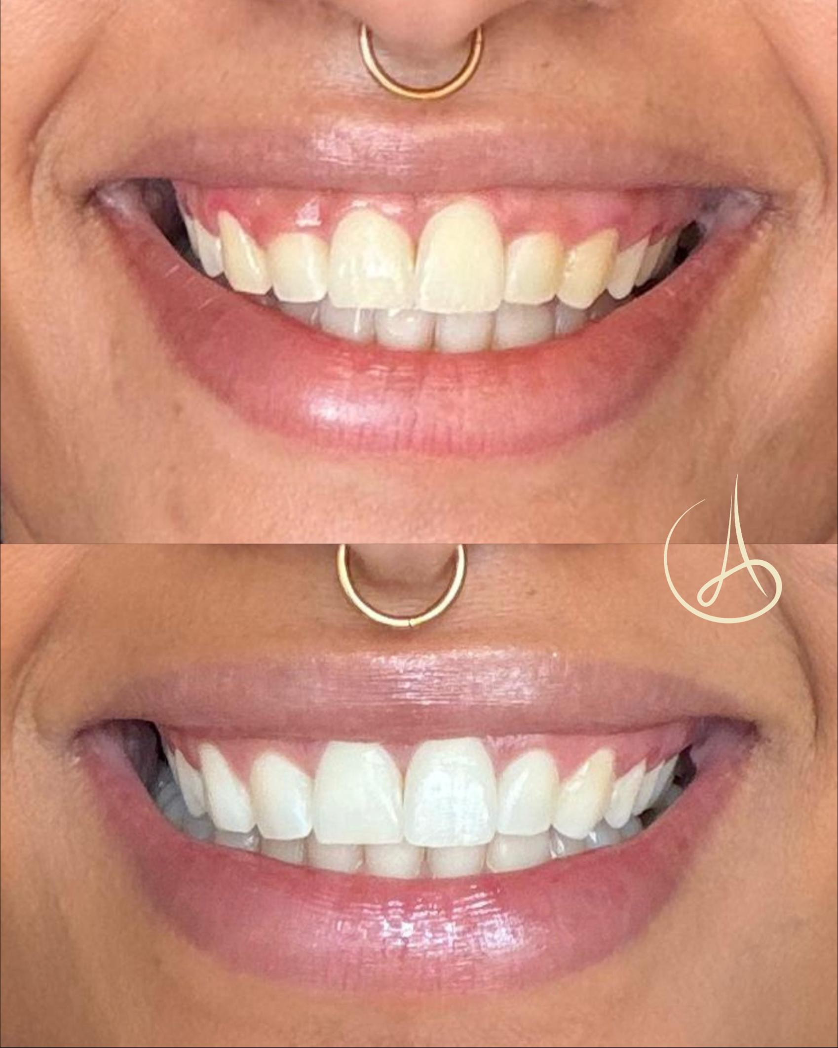Gengivoplastia