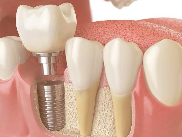 Implantes Dentários
